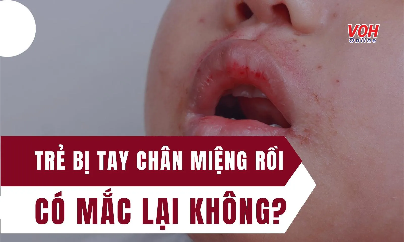 Trẻ bị Tay Chân Miệng rồi có mắc lại không?