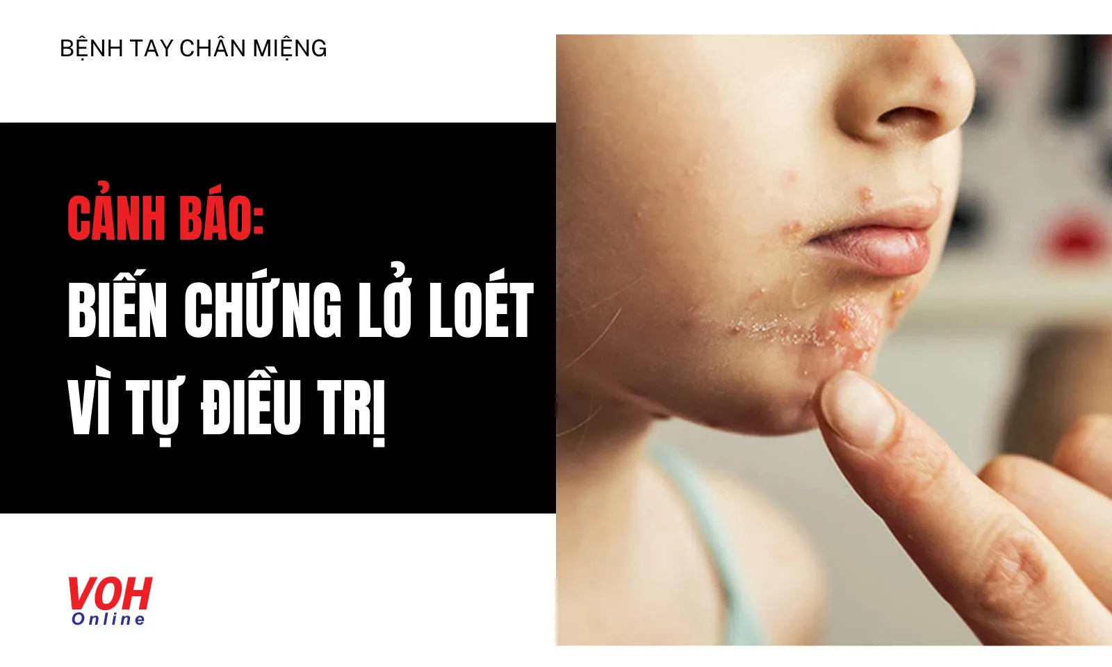 Trẻ bị biến chứng lở loét vì cha mẹ tự điều trị Tay Chân Miệng