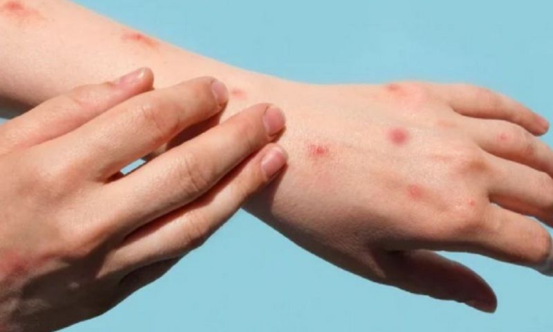 TPHCM: Phát hiện 63 ca đậu mùa khỉ trong 2 tháng