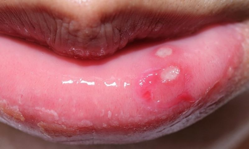 Nên làm gì nếu bị nhiệt miệng?