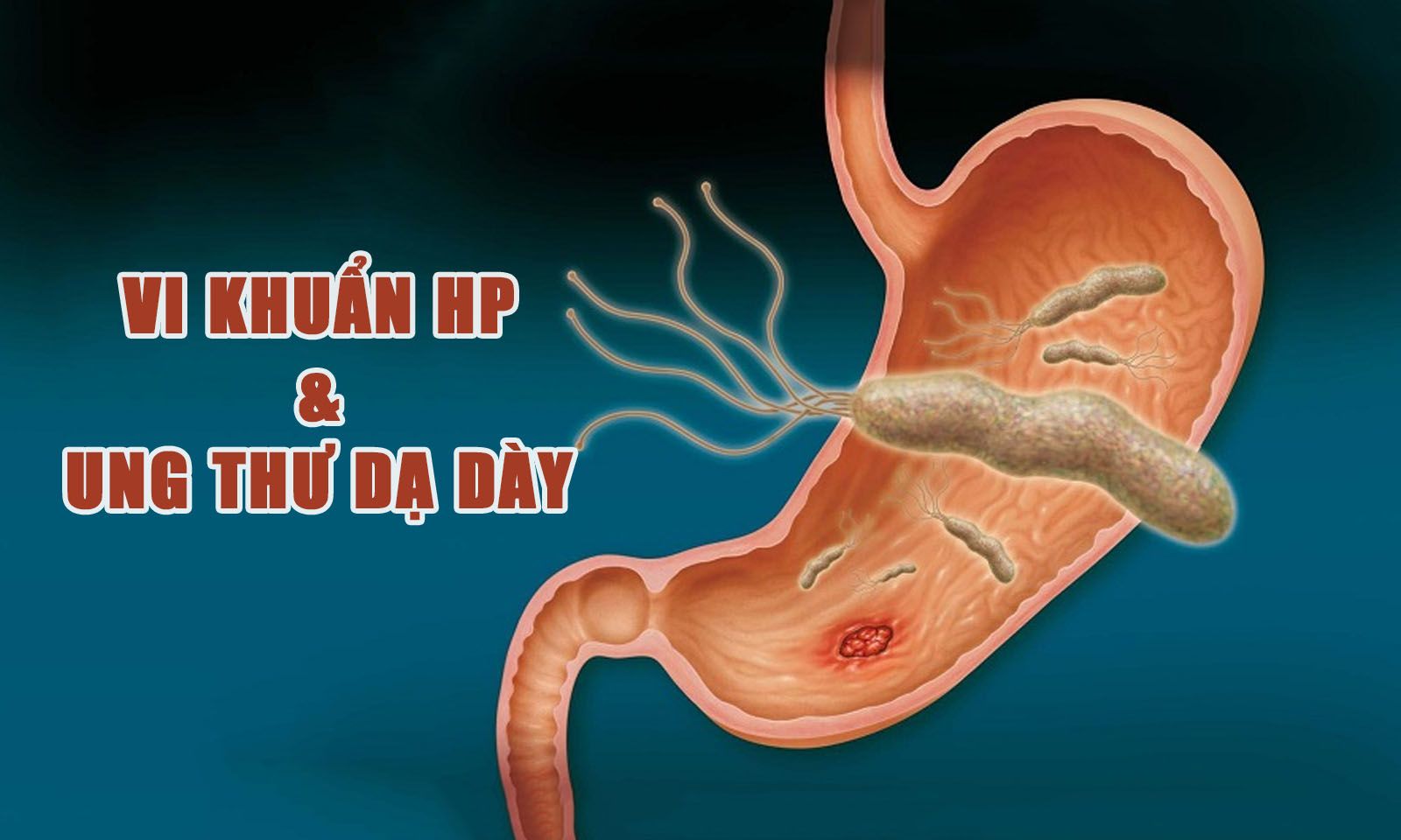 Có phải người bị nhiễm khuẩn HP đều sẽ bị ung thư dạ dày?