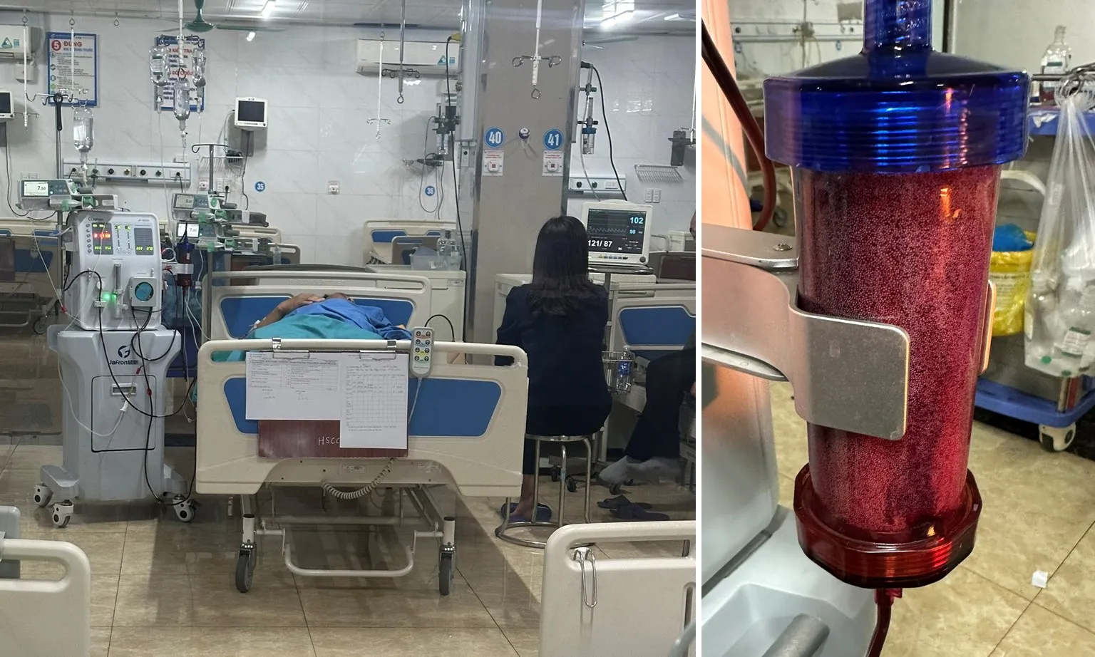 Cứu sống nam bệnh nhân 45 tuổi tăng mỡ máu, viêm tụy cấp nhờ phương pháp lọc máu hấp phụ