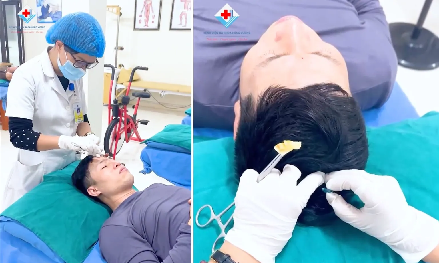 Điều trị viêm xoang sau 15 phút nhờ phương pháp cấy chỉ