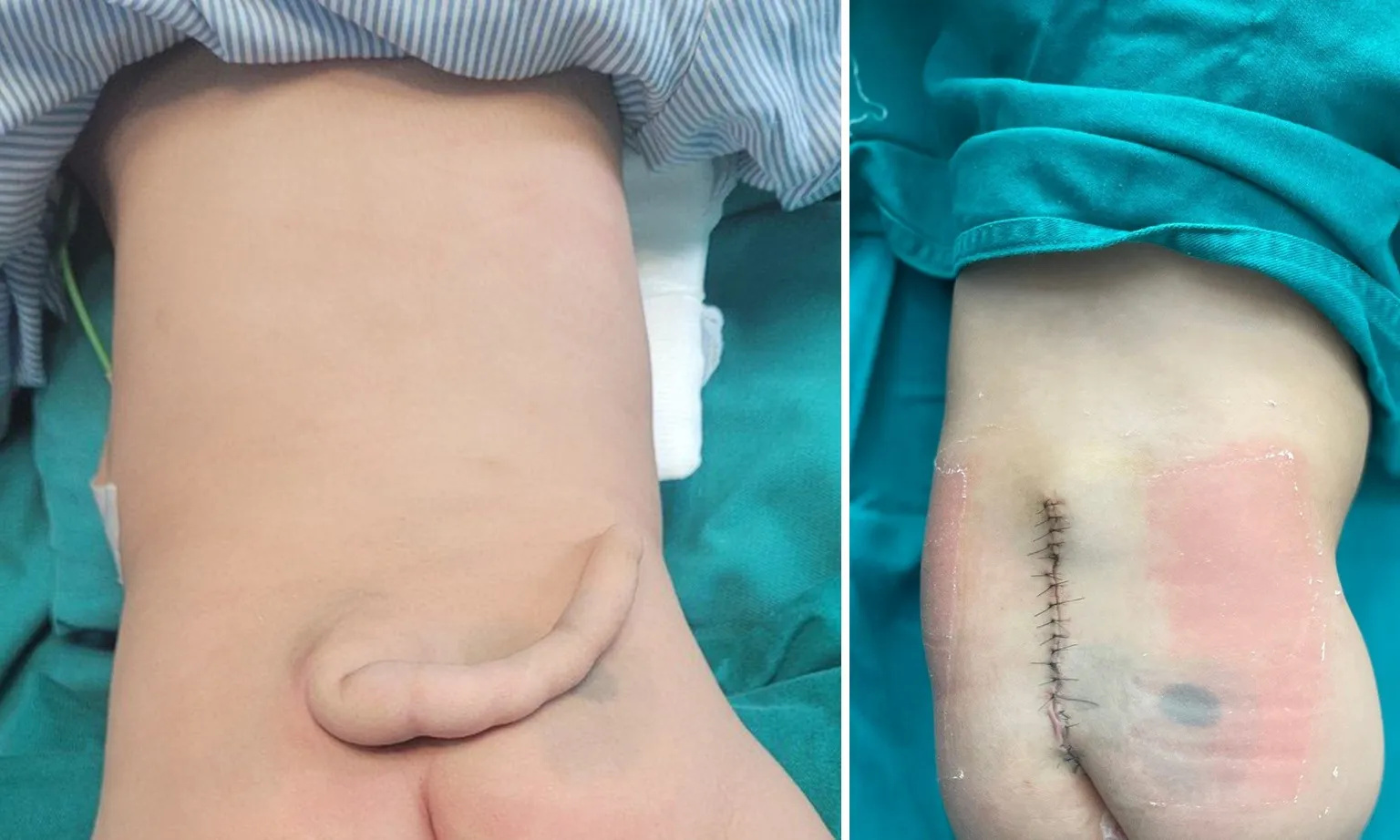 Phẫu thuật cho bé có ‘đuôi’ bất thường dài 14cm vùng cùng cụt