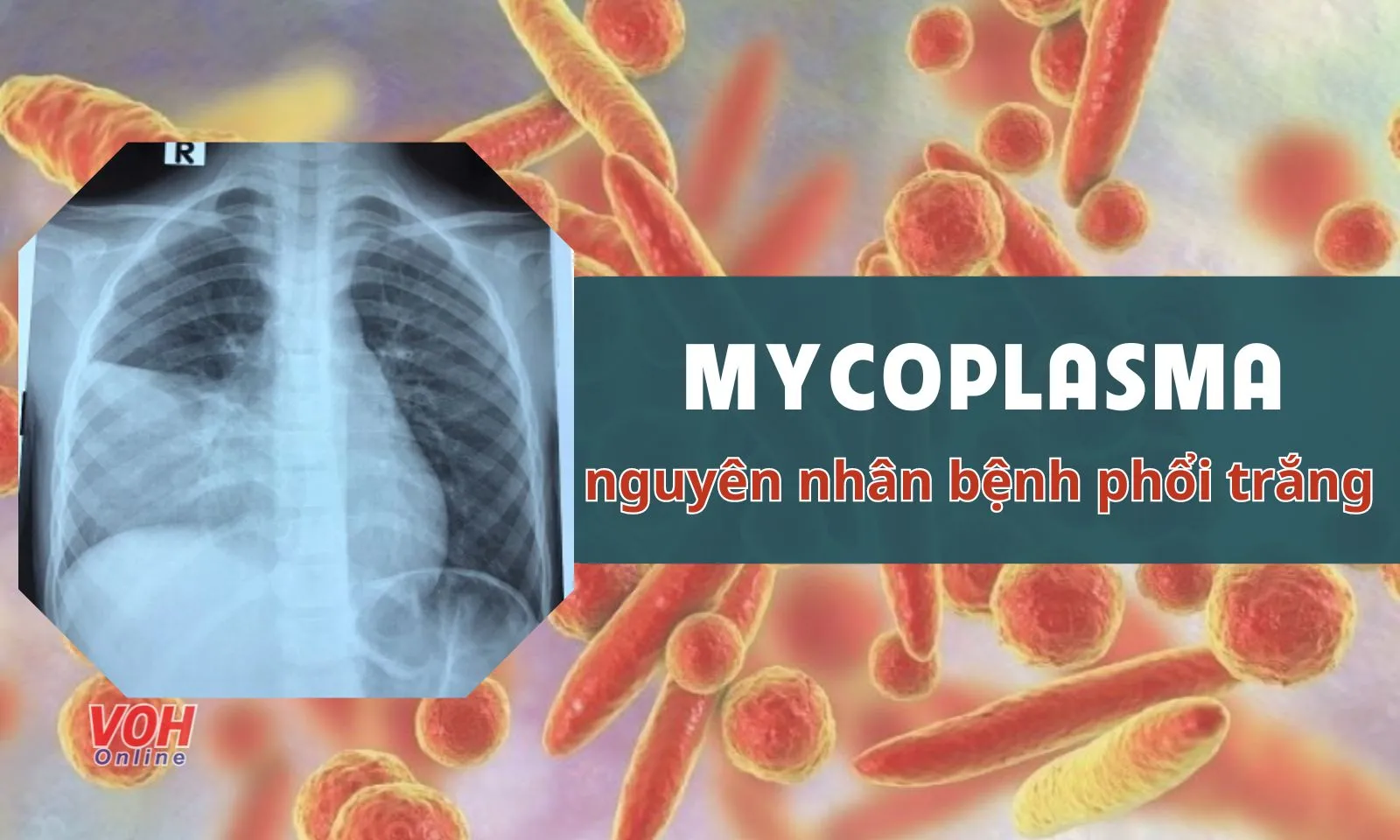 Mycoplasma - Nguyên nhân hàng đầu gây bệnh phổi trắng ở nhiều nơi