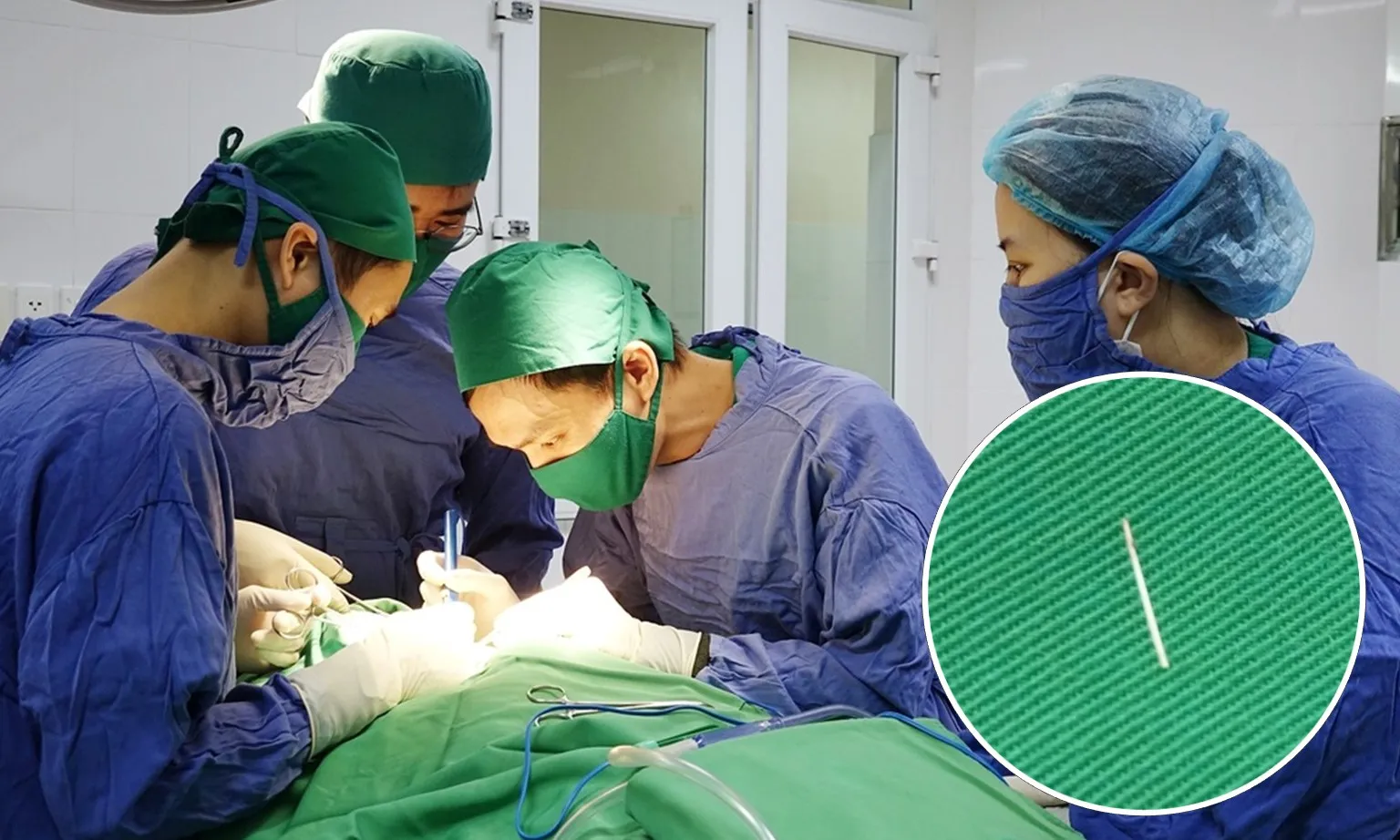 Cụ ông phải phẫu thuật cổ chỉ vì chiếc xương cá 1 cm