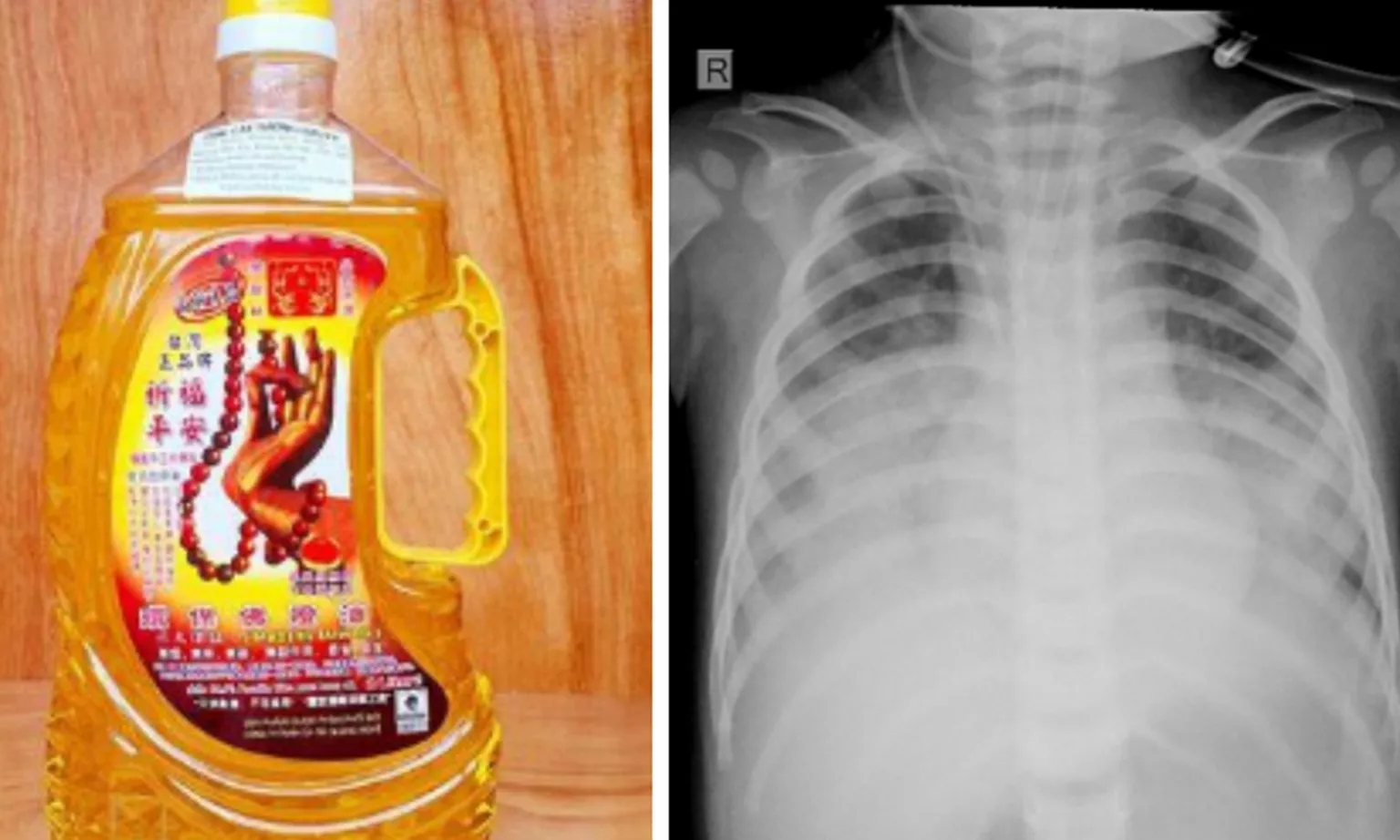 Nghệ An: Bé 15 tháng tuổi nguy kịch vì uống nhầm dầu thắp đèn