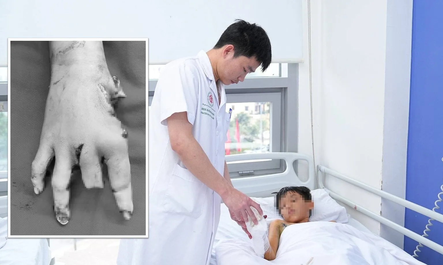 Cậu bé 12 tuổi nát tay vì tự chế pháo theo hướng dẫn trên mạng