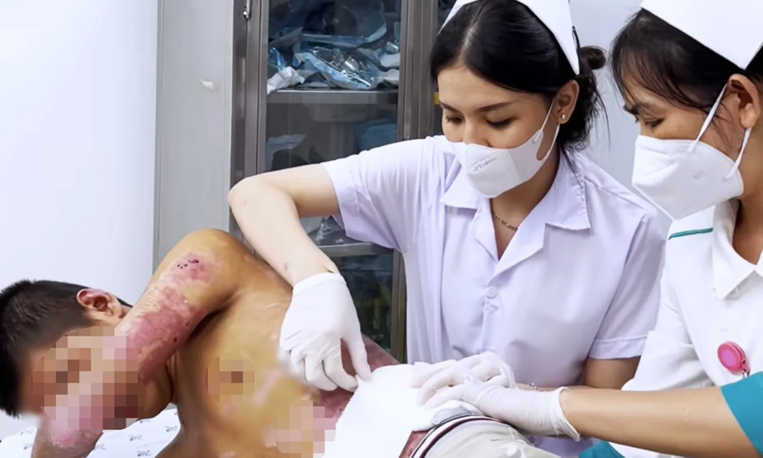 Bé trai 15 tuổi bỏng toàn thân do gạch nóng đổ lên người