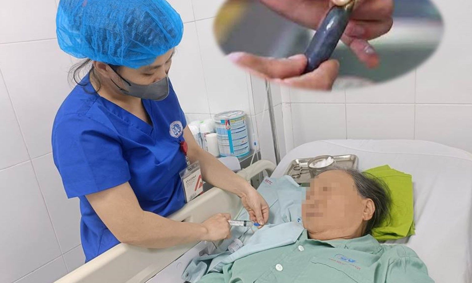 Người phụ nữ nguy kịch vì nuốt mật cá trôi để… bồi bổ