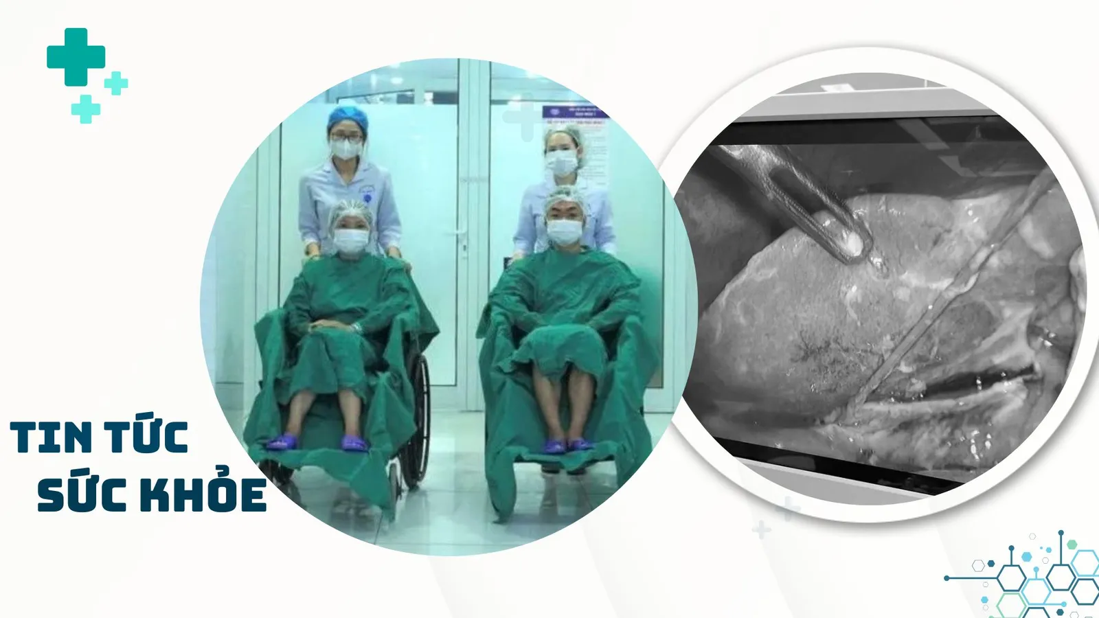 Nhịp Sống Khỏe 18/1: Huấn luyện can thiệp tim mạch trên tim heo tại Việt Nam | Nguy cơ tái phát bệnh dịch tả heo châu Phi