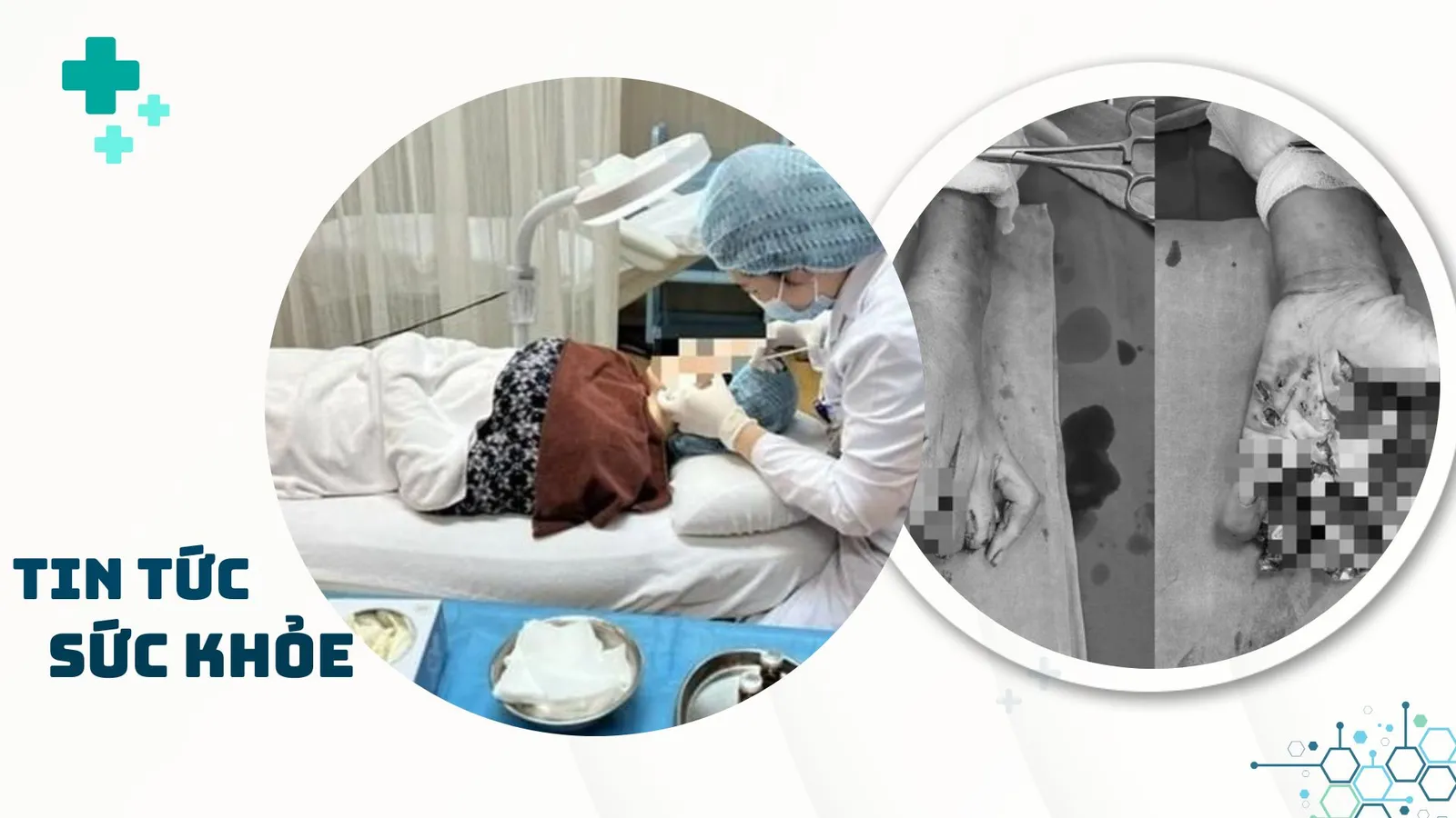 Nhịp Sống Khỏe 20/1: Dấu hiệu cảnh báo viêm màng não ở trẻ | Khuyến cáo của bác sĩ khi làm đẹp đón Tết