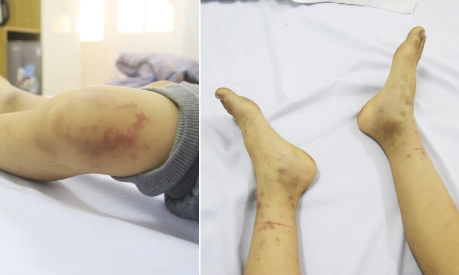 Bệnh viêm mao mạch dị ứng nguy hiểm như thế nào đối với trẻ?