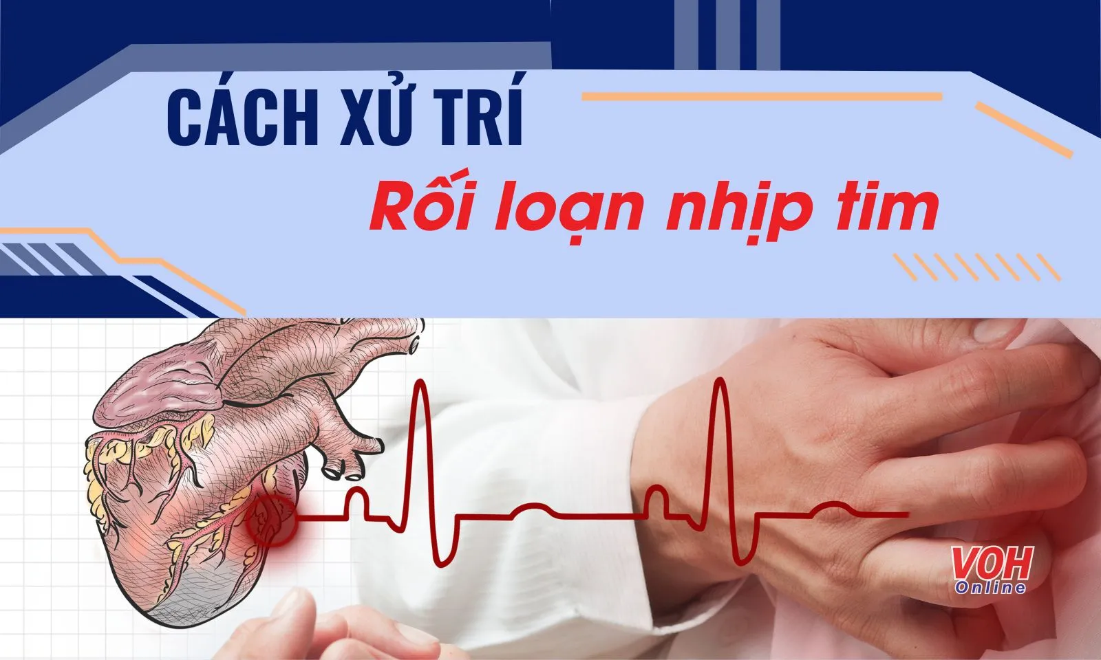 Cách xử trí khi bị rối loạn nhịp tim