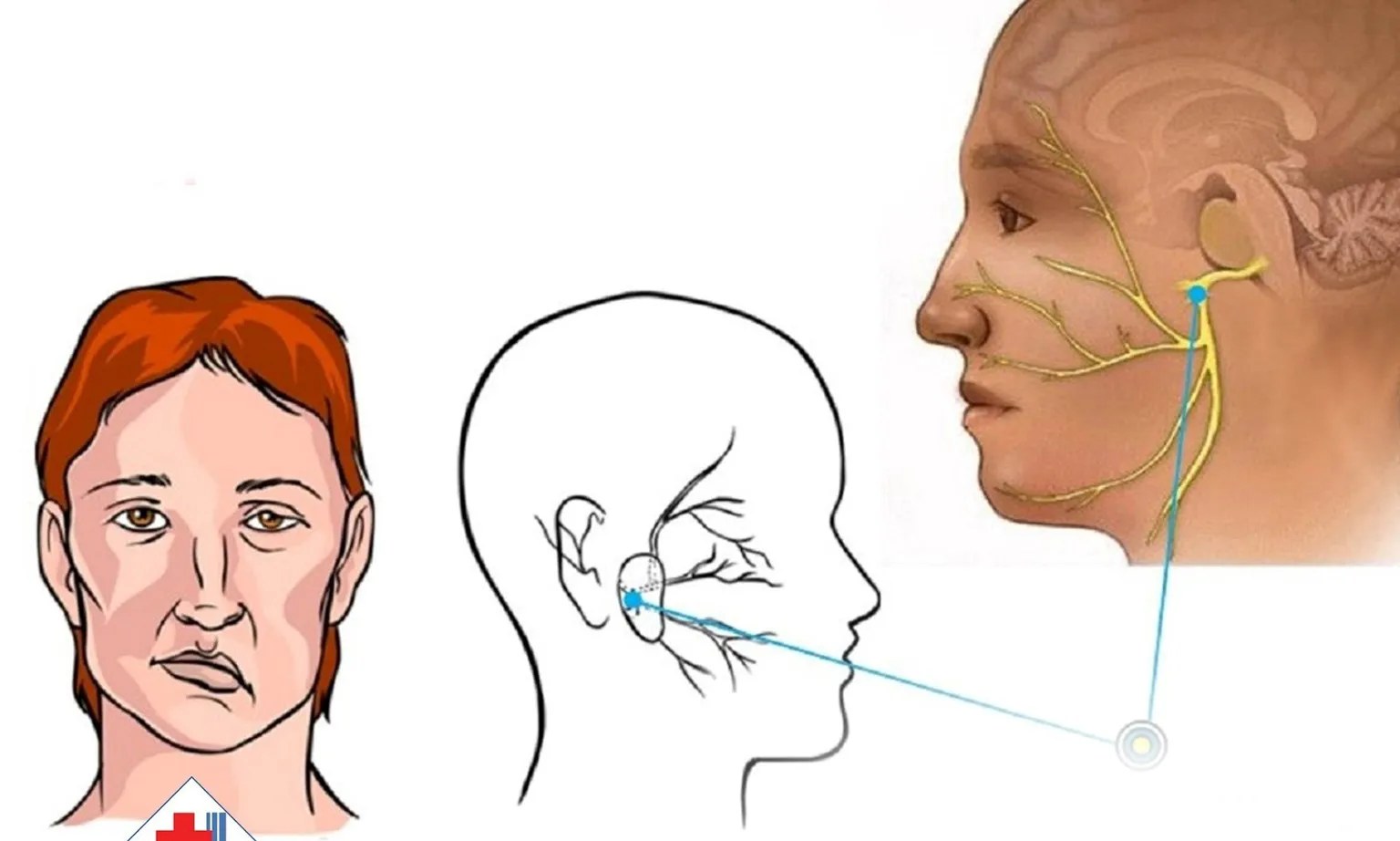 Bé gái liệt dây thần kinh số VII ngoại biên vì thời tiết lạnh