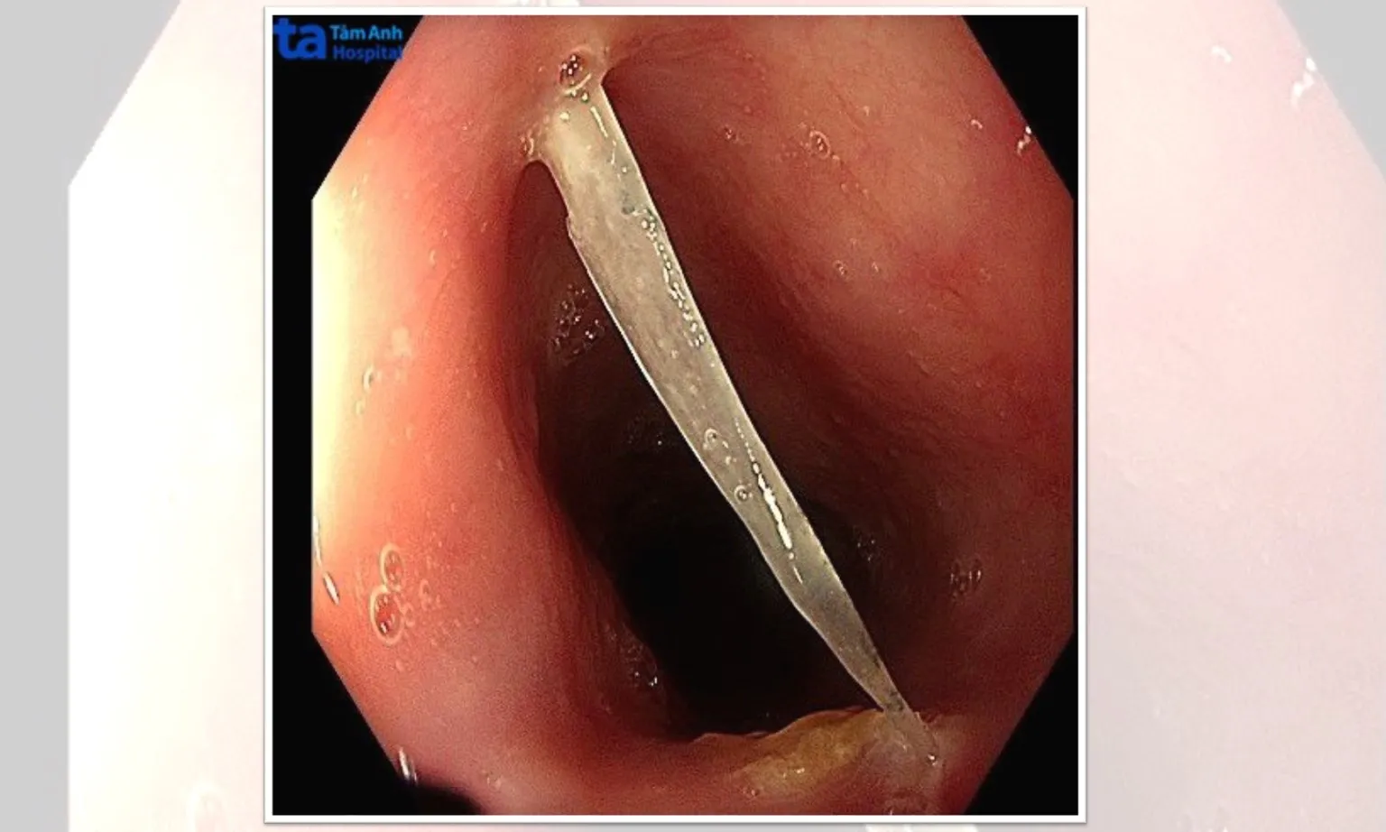 Xương cá 15 mm đâm vào thực quản