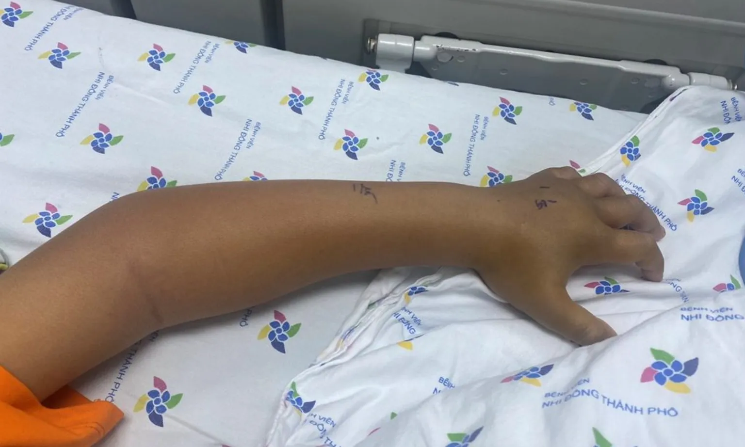 Bé trai rối loạn đông máu nặng vì bị rắn lục cắn vào ngày mùng 1 Tết