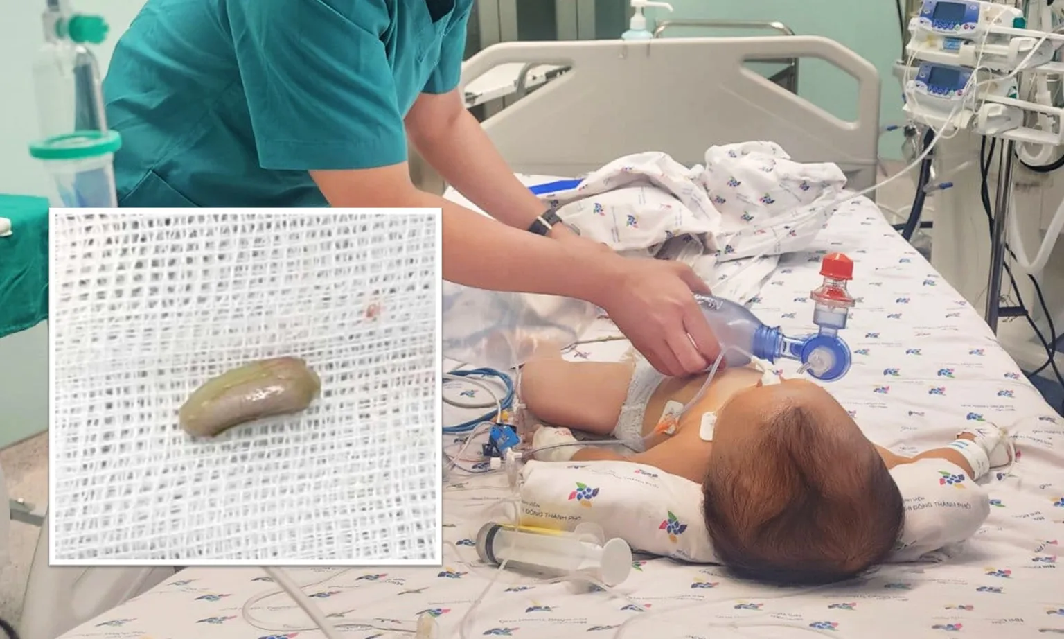 Bé 9 tháng tuổi sặc hạt đậu đũa nguy hiểm