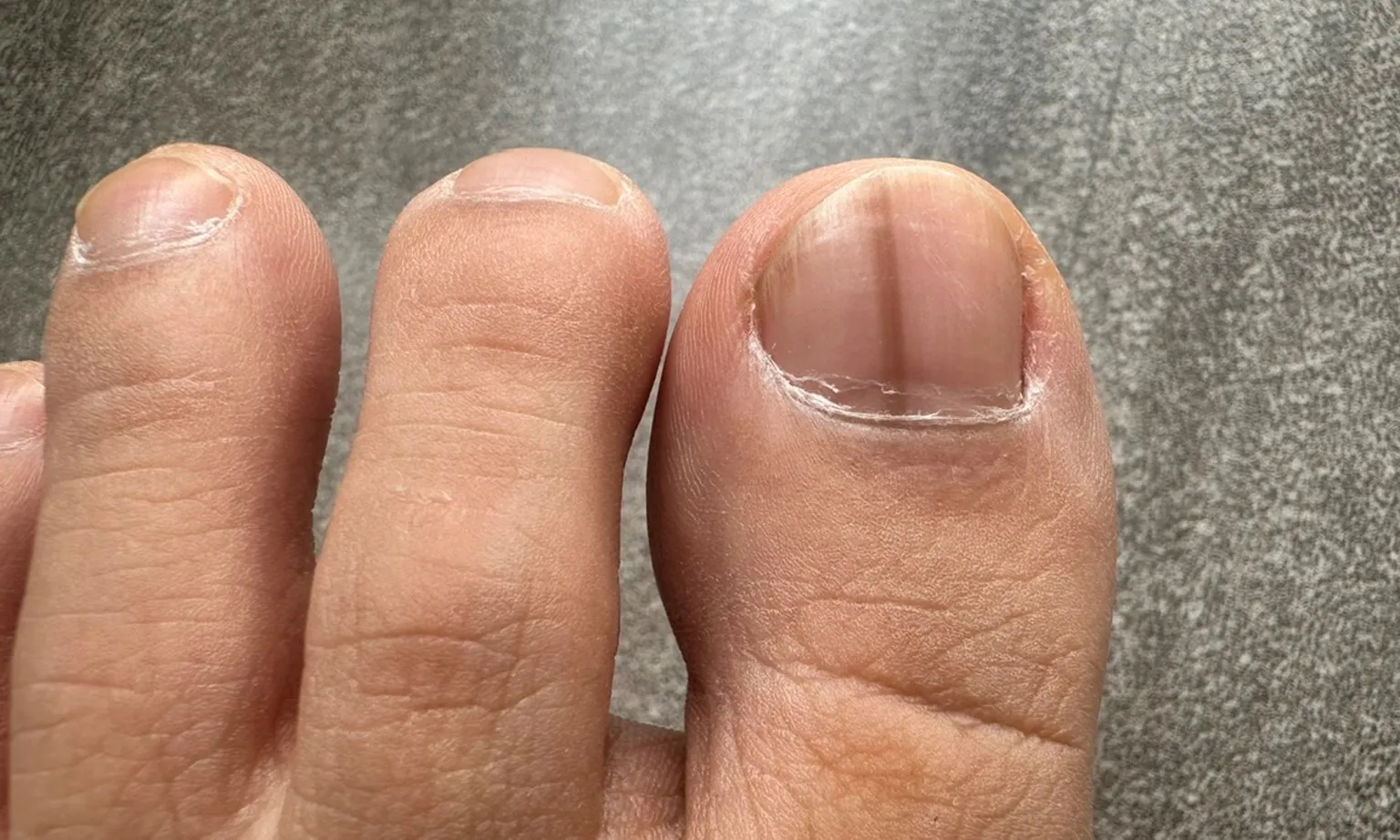 Móng tay chân có sọc đen có phải ung thư hắc tố dưới da?