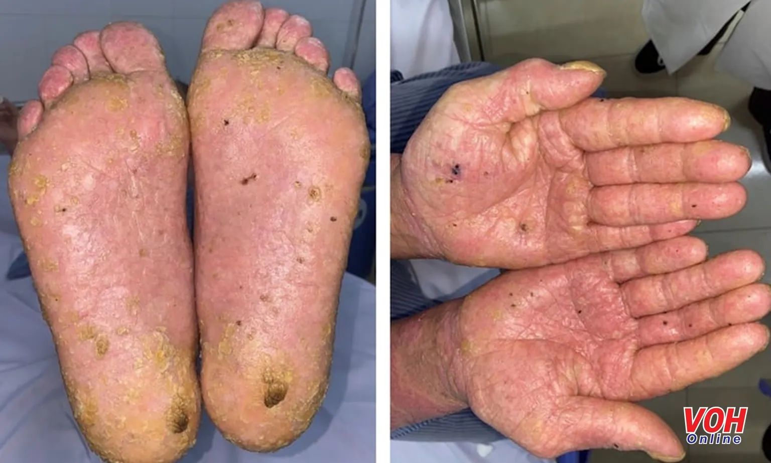 Nhiễm độc thạch tín nặng vì uống nước giếng khoan và uống thuốc không rõ nguồn gốc