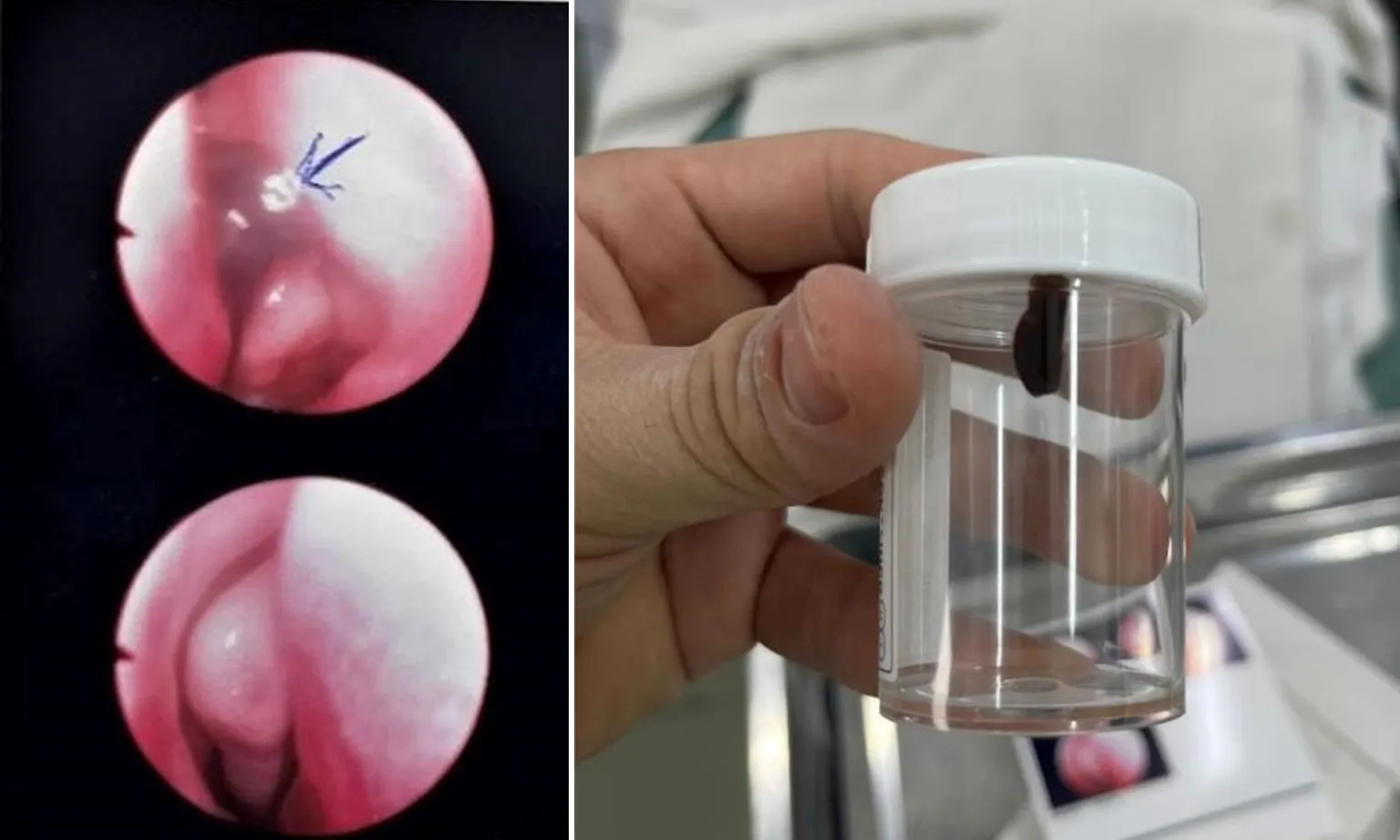 Bé gái hơn 1 tuổi bị vắt chui vào mũi sau khi đi dã ngoại cùng gia đình