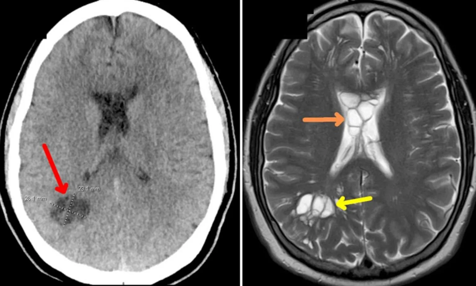 Đi khám vì đau nửa đầu, người đàn ông được phát hiện có sán dây trong não