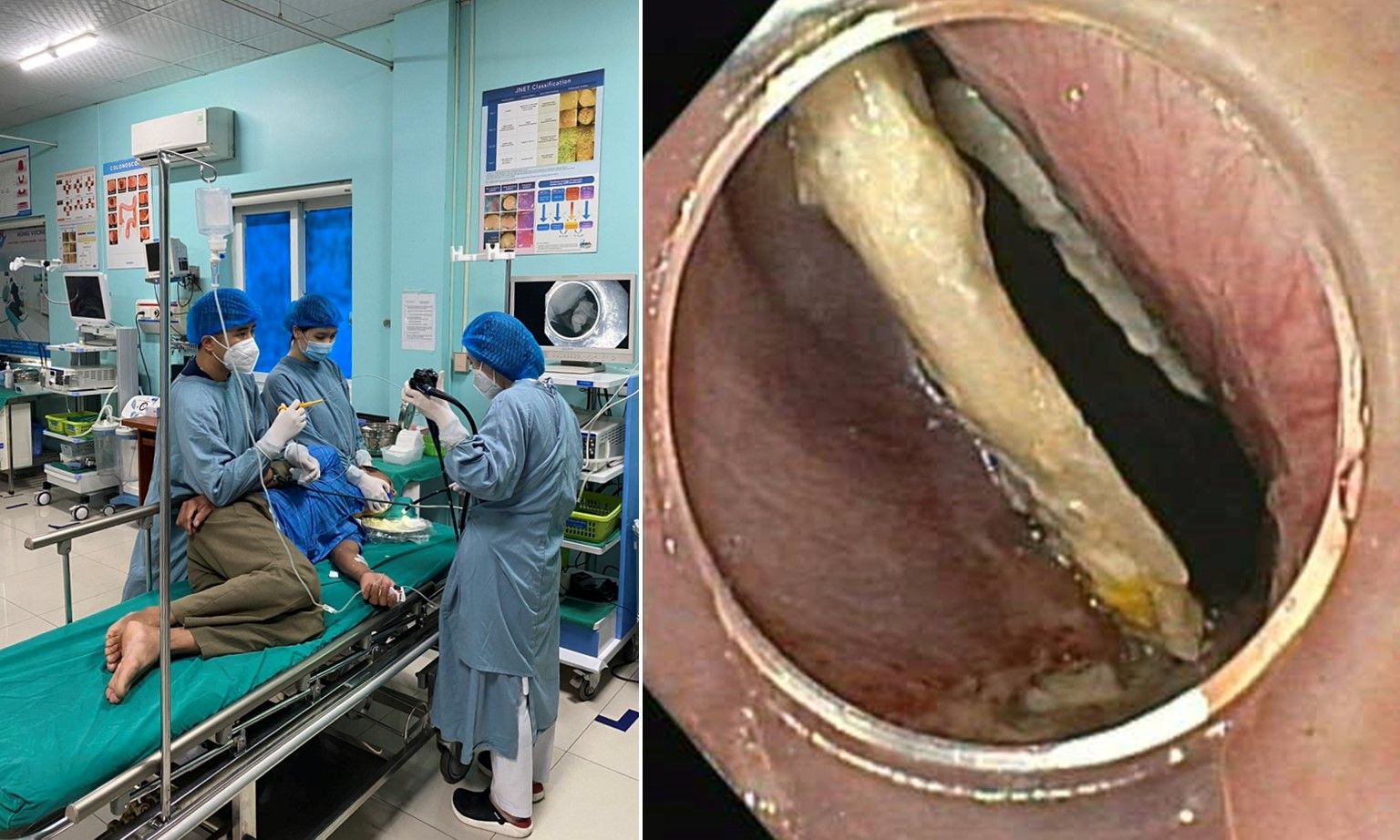 Xương gà đâm sâu vào thực quản người đàn ông 47 tuổi