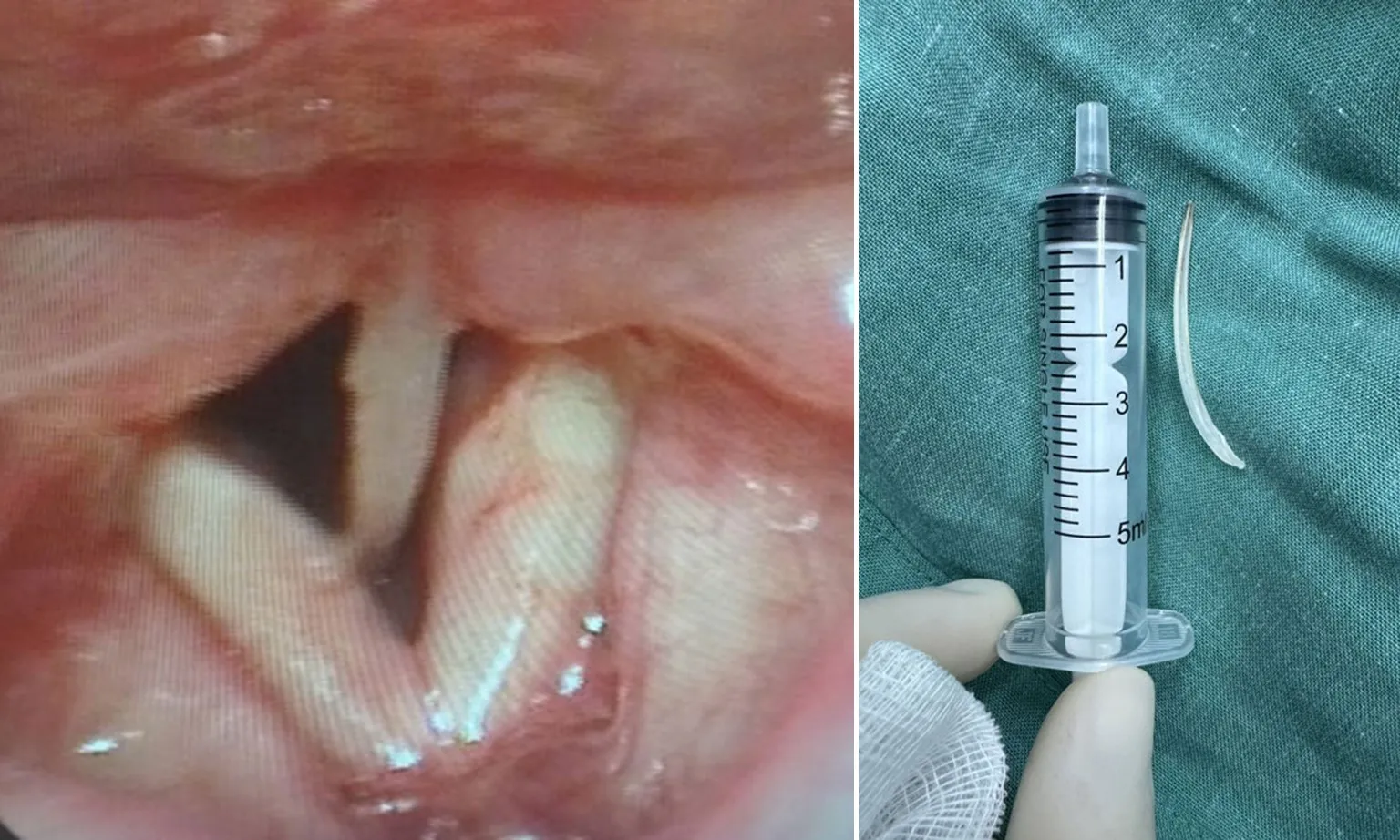 Cụ bà 86 tuổi bị xương cá xuyên từ thực quản sang khí quản