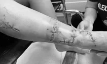 Cấp cứu kịp thời bé trai bị kiếng cắt đứt mạch máu, thần kinh, gân cổ chân