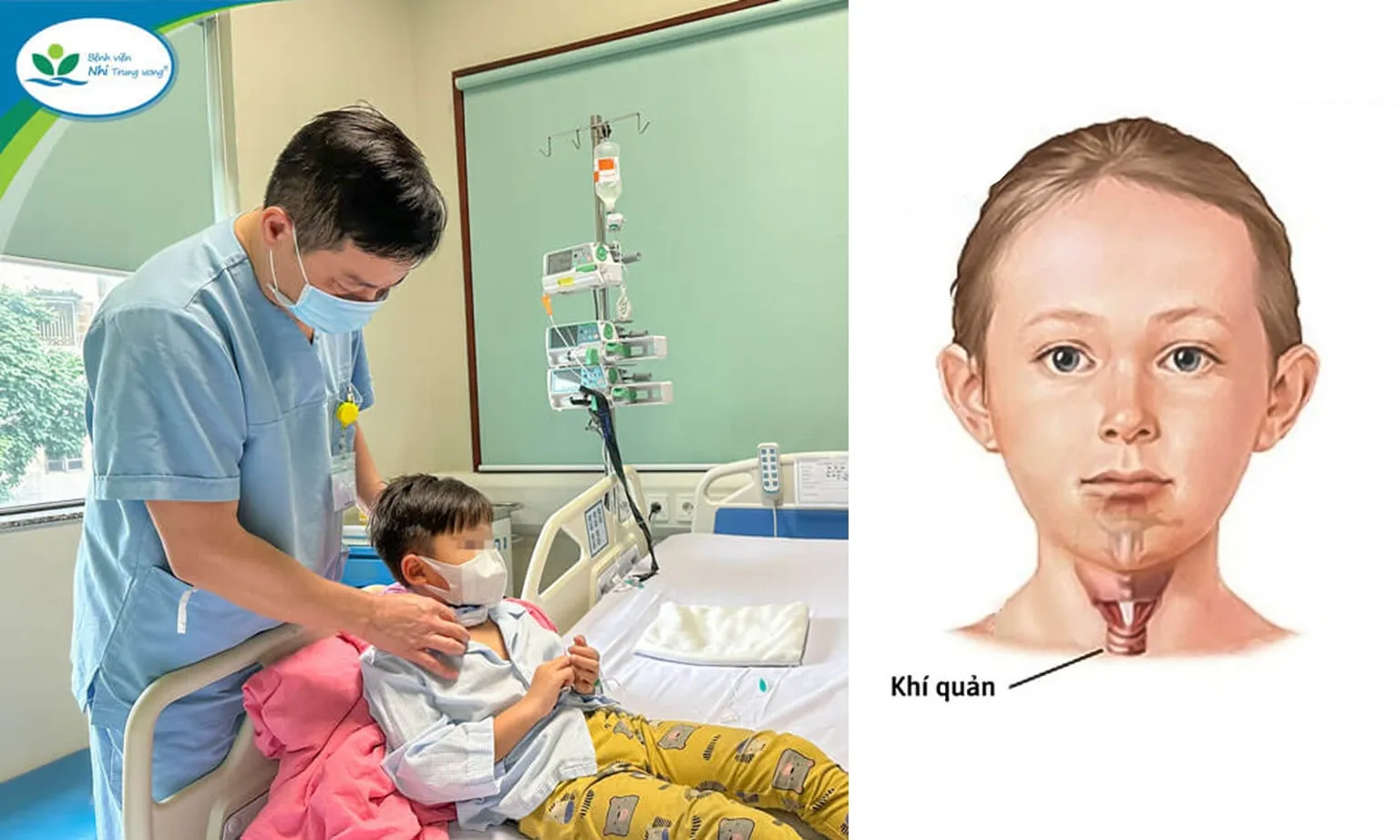 Ngã đập vùng cổ vào góc kệ tivi, bé trai 7 tuổi bị vỡ khí quản