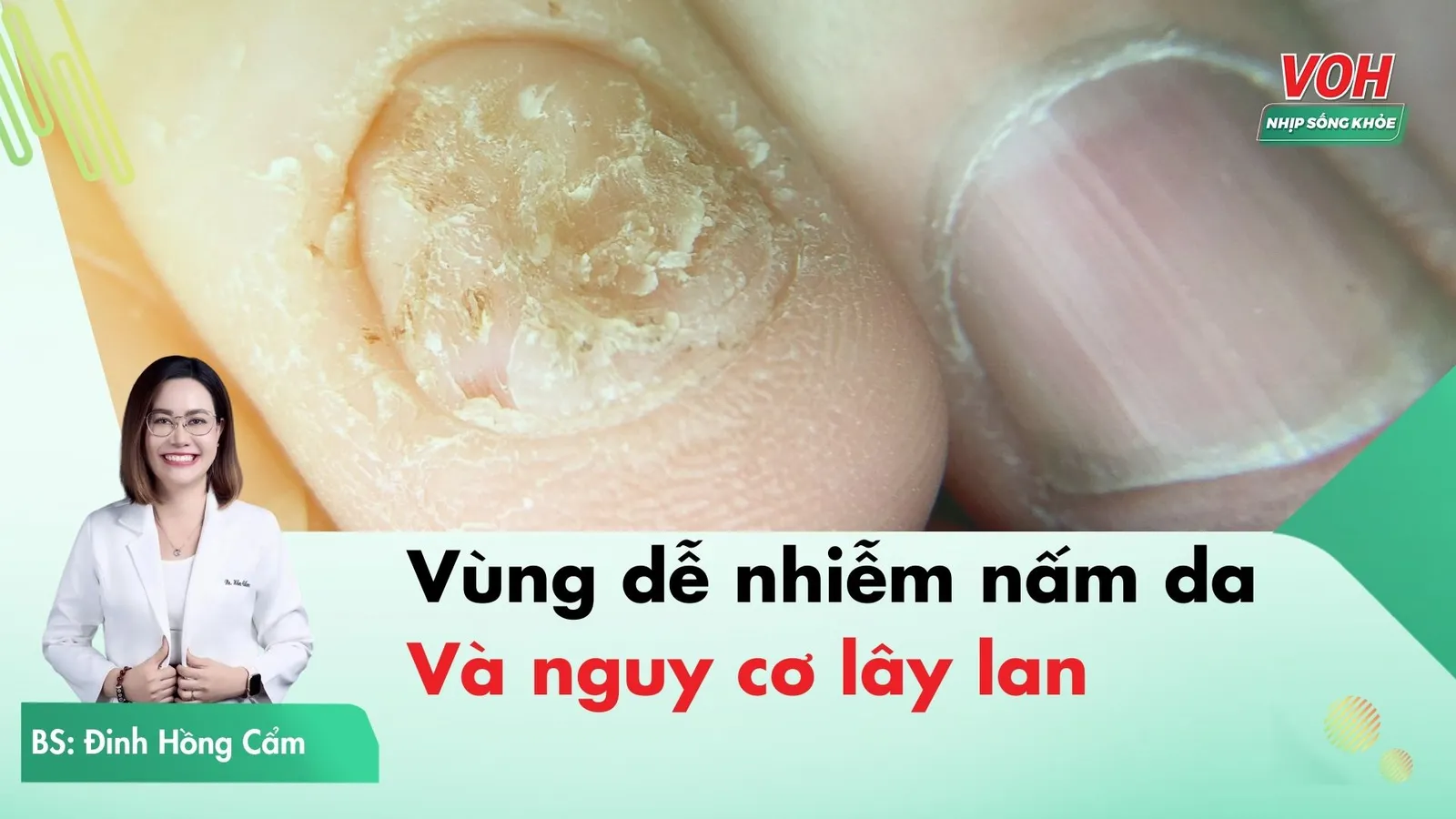 Nấm da: Vùng dễ bị nhiễm và nguy cơ lây lan