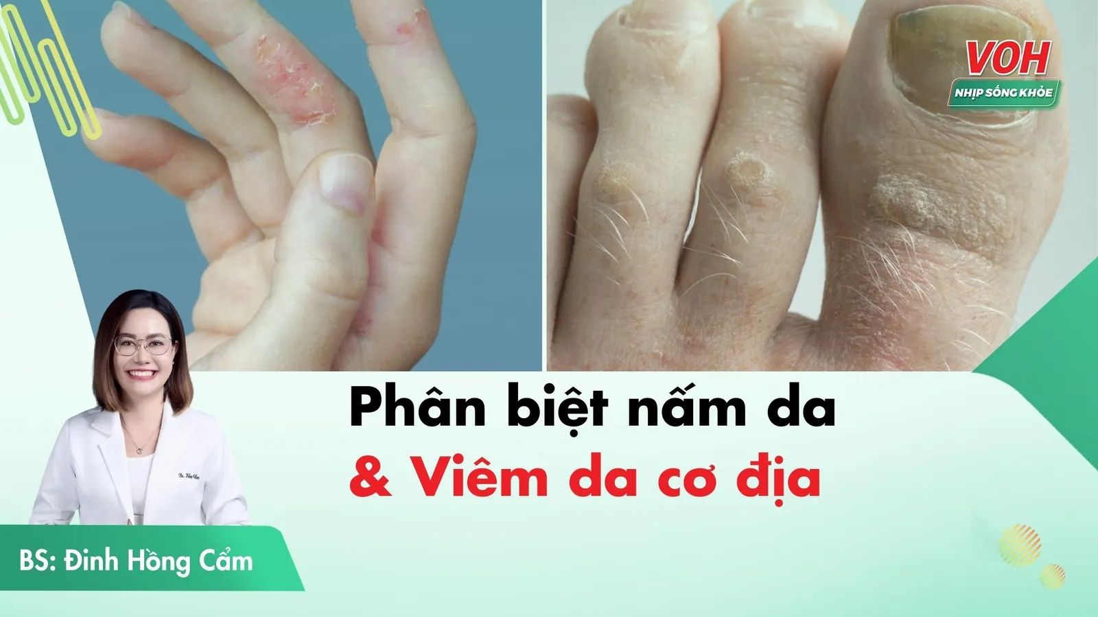 Phân biệt bệnh nấm da và viêm da cơ địa